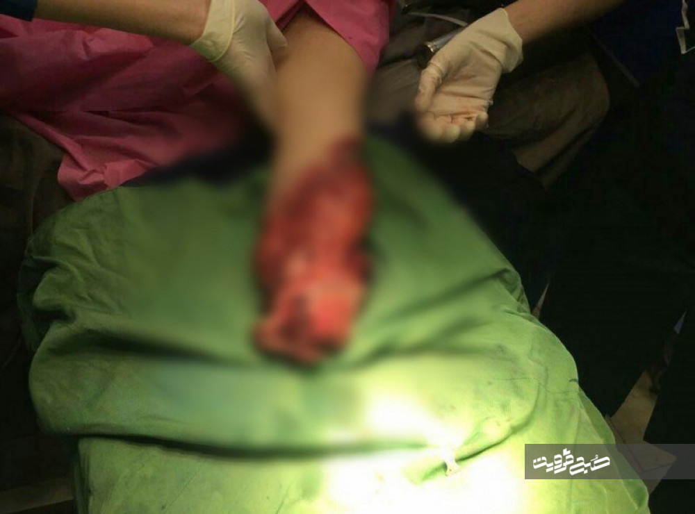 مچ دست قطع شده زنی در مرکز شهید رجایی قزوین پیوند زده شد